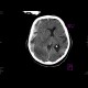 Acute subdural hemorrhage, active bleeding, subfalcine herniation: CT - Computed tomography